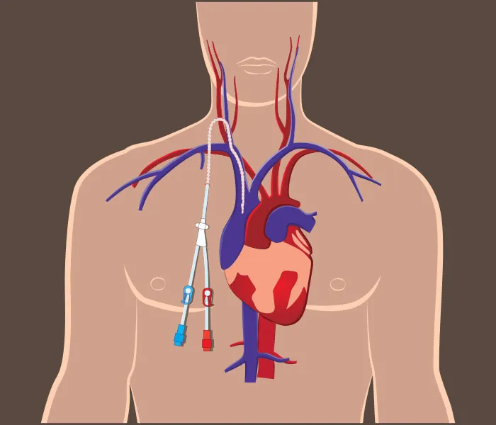 Dialysis catheter care during home hemodialysis treatment